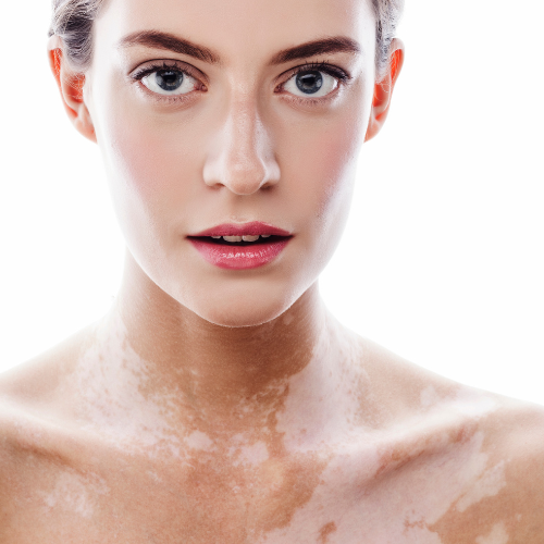 Vitiligo