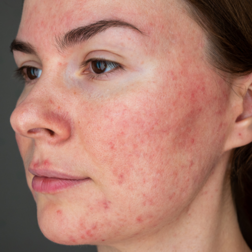 Rosacea