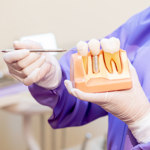 MISSING TEETH REPLACEMENT