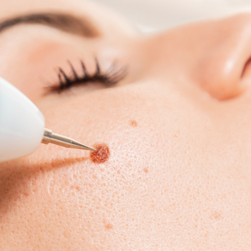 Skin tags , warts and moles