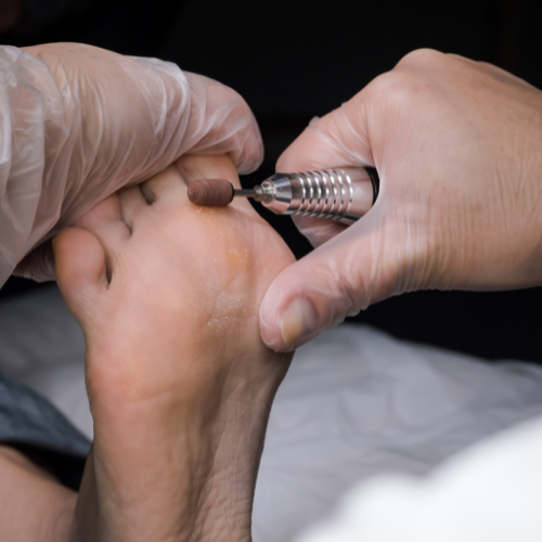 Corns and calluses