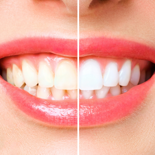 TEETH WHITENING